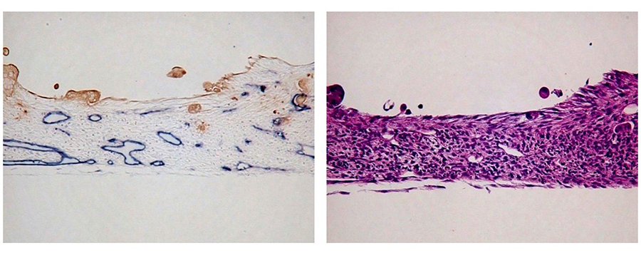 3D細胞培養技術により作製した人工組織の標本切片 左図（切片の免疫染色結果）：組織内に血管管腔が形成　（がん部は茶色、微小血管は青色) 右図（切片のHE染色結果）：細胞が立体的に積層　（細胞核は紫色）